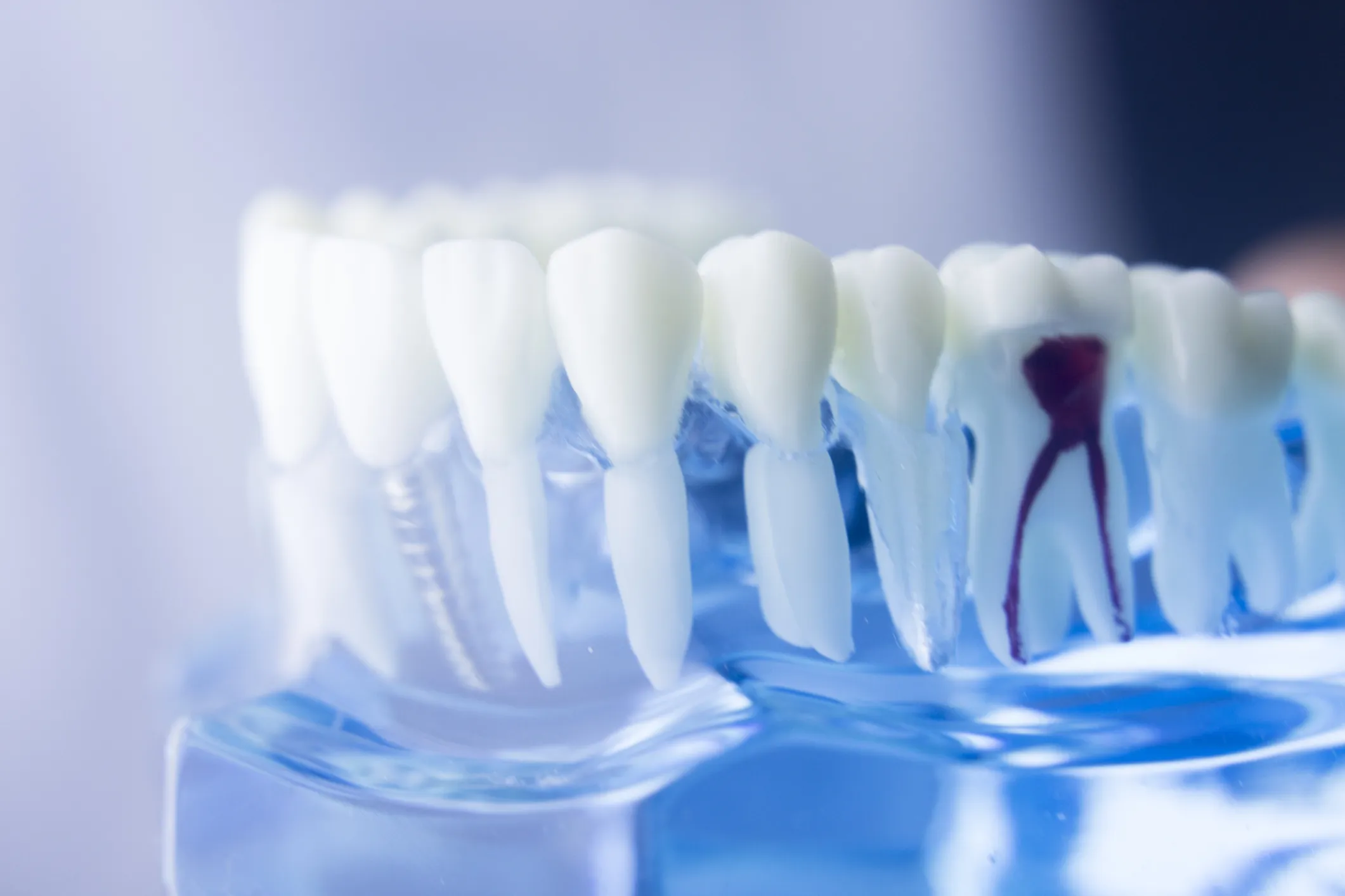 Modell des Wurzelkanals